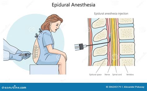 Illustrazione della procedura di inserimento del catetere epidurale
