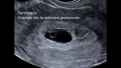 Ecografia di un embrione