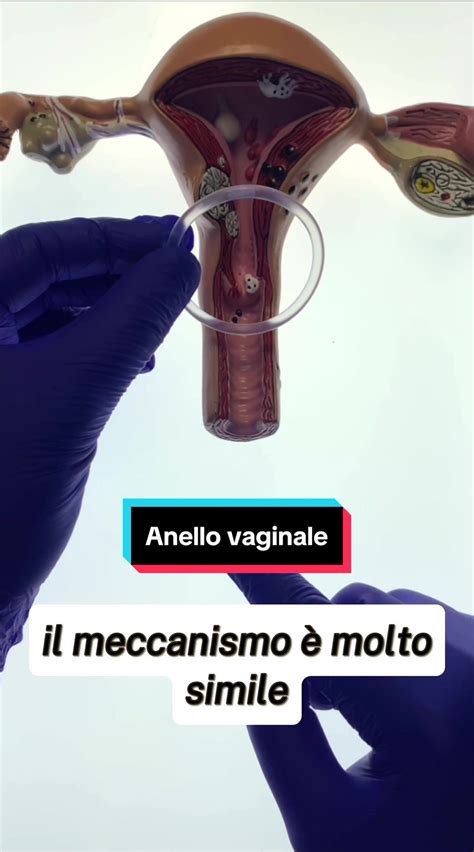 Schema di inserimento ovulo vaginale