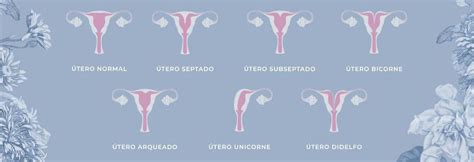 Diagramma di un utero con diversi tipi di fibromi