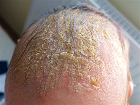 Neonato con crosta lattea sul cuoio capelluto