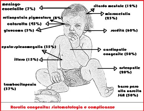 Schema della sindrome da rosolia congenita con le sue principali manifestazioni