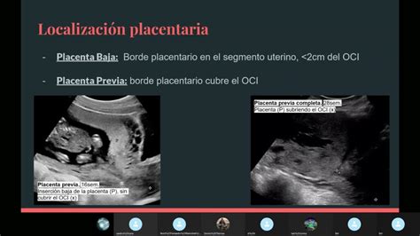 Ecografia di una placenta previa che copre parzialmente l'orifizio cervicale interno.