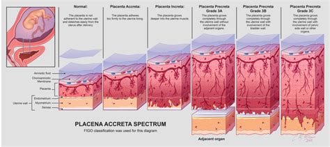 Schema che illustra i segni ecografici associati alla placenta accreta spectrum: perdita della clear zone, lacune placentari, interruzione della parete vescicale e ipervascolarità uterovescicale.