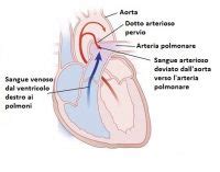 Diagramma che illustra lo shunt sinistro-destro in un dotto arterioso pervio