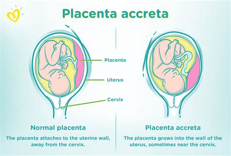 Placenta accreta