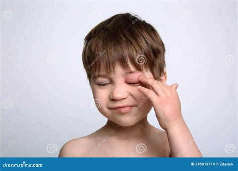 bambino con occhio rosso