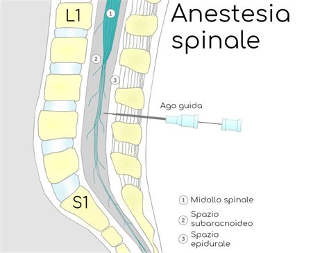 Schema comparativo tra anestesia epidurale e spinale
