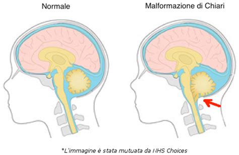 Immagine RM che mostra l'erniazione delle tonsille cerebellari nella malformazione di Chiari I