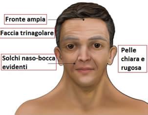 Dismorfismi facciali tipici della Sindrome di Noonan