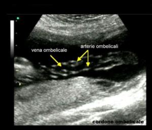 Ecografia del cordone ombelicale