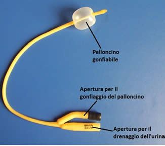 Catetere di Foley per induzione del parto
