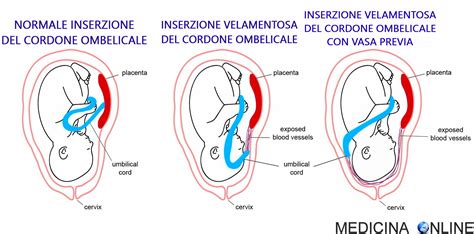 Ecotografia che mostra un giro di cordone ombelicale attorno al collo fetale
