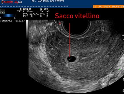 Ecografia precoce con camera gestazionale e sacco vitellino