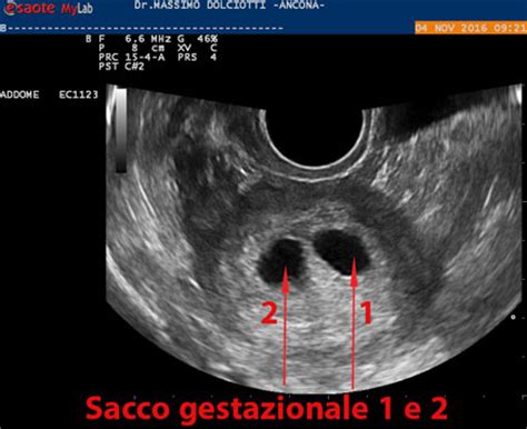 Ecografia con due sacchi vitellini indicativi di gravidanza gemellare bicoriale