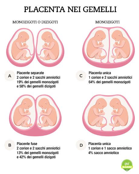 Schema che illustra le diverse combinazioni di corionicità e amnionicità nelle gravidanze gemellari