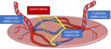 Diagramma che illustra lo squilibrio del flusso sanguigno nella sindrome da trasfusione feto-fetale (TTTS)