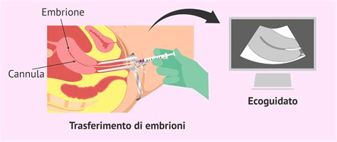 Microscopio per la fecondazione in vitro e trasferimento embrionale