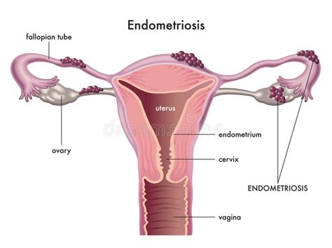 Illustrazione anatomica dell'endometriosi