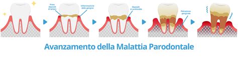 Illustrazione di una bocca sana contrapposta a una bocca affetta da malattia parodontale