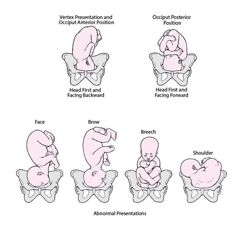 Diagramma che illustra le diverse presentazioni fetali (ceflica, podalica, trasversale)