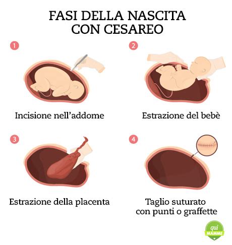 Infografica che confronta i rischi del parto vaginale e del parto cesareo