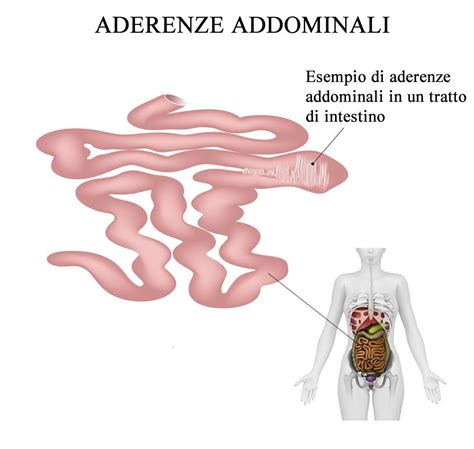 Illustrazione che mostra la formazione di aderenze post-chirurgiche tra organi addominali
