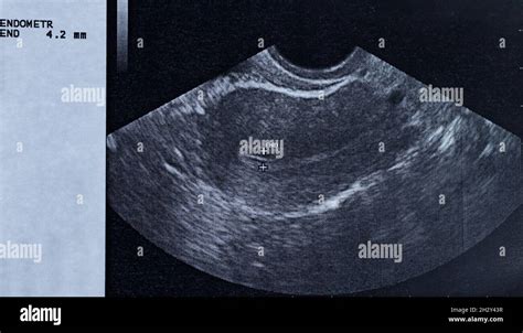 Ecografia che mostra un embrione in utero