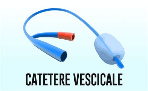 Illustrazione di un catetere vescicale