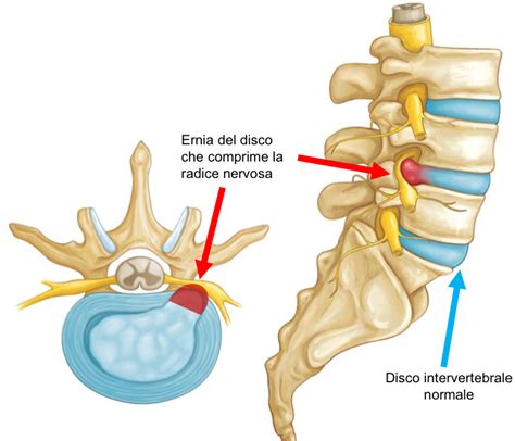 Mappa del corpo umano che illustra la propagazione del dolore da ernia del disco lombare