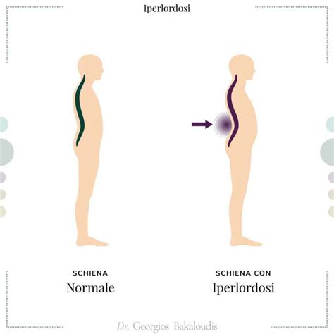 Illustrazione della postura di una donna incinta con iperlordosi lombare