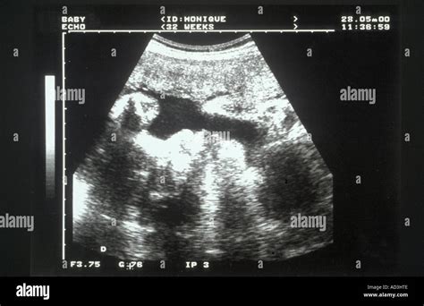 Ecografia di un feto in utero