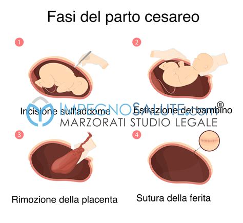 Schema dell'utero con evidenziata la cicatrice di un cesareo