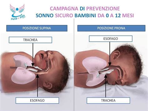 Schema che illustra la posizione anti-reflusso a 30 gradi