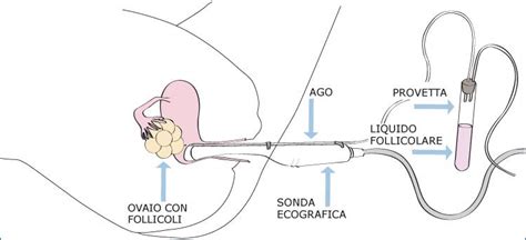 Infografica che illustra i passaggi del prelievo ovocitario
