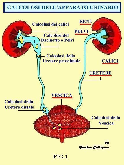 Schema che illustra il percorso di un calcolo renale attraverso il tratto urinario