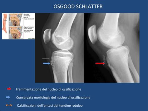 ginocchio di un bambino con segni di Osgood-Schlatter