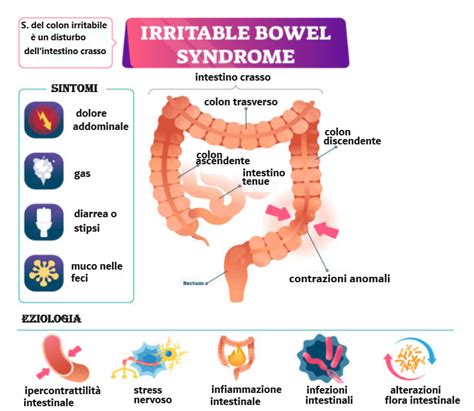 Schema dei sintomi della sindrome del colon irritabile