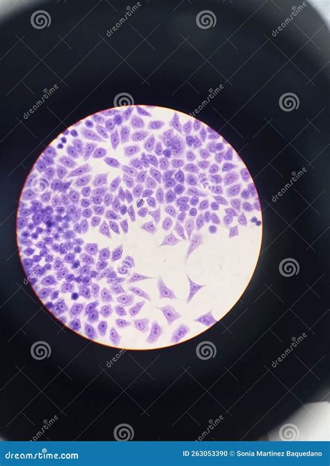Immagine microscopica di un villo placentare con segni di malperfusione