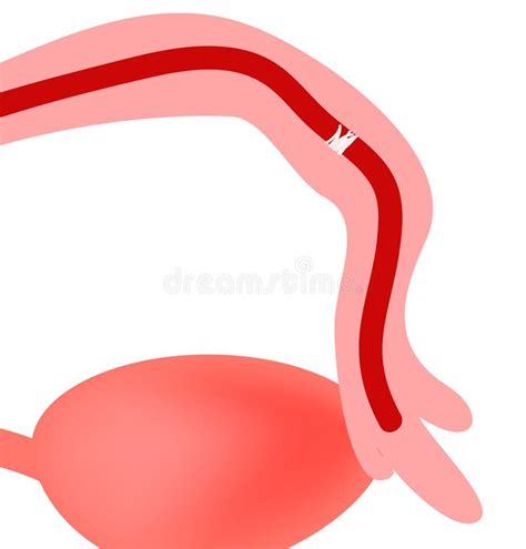 diagramma dell'utero e delle tube di Falloppio