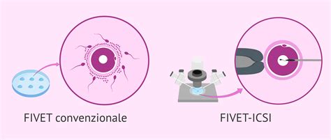 Infografica: Confronto tra FIVET e IUI