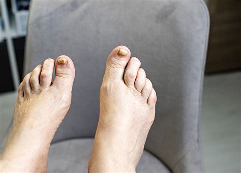 Unghie dei piedi con segni di onicodistrofia