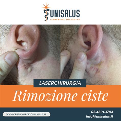 Illustrazione di diverse tecniche chirurgiche per la rimozione di cisti