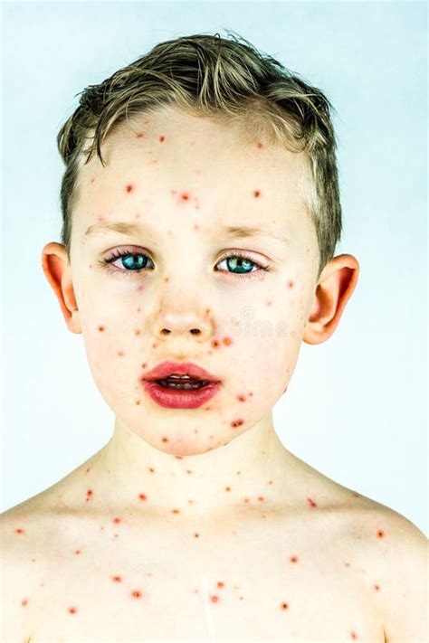 Fotografia di un bambino con eruzione cutanea da varicella