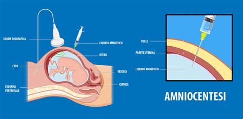 Ecografia durante l'amniocentesi