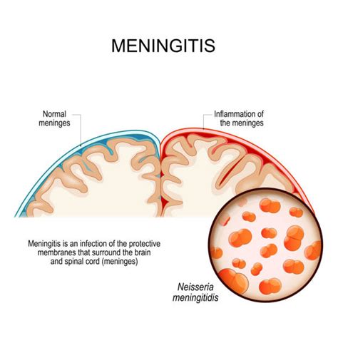 Illustrazione del batterio Neisseria meningitidis