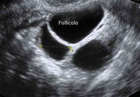 Ecografia transvaginale per monitoraggio ovulazione