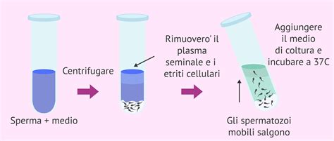 Schema del processo di Swim-up per la preparazione dello sperma