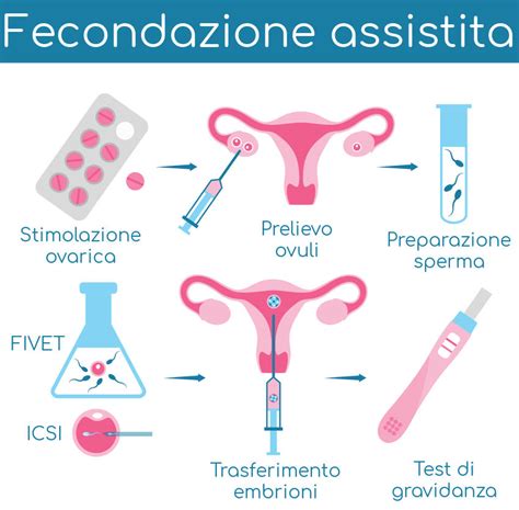Diagramma del processo di fecondazione assistita ICSI