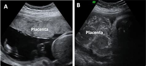 Ecografia che mostra una placenta anteriore